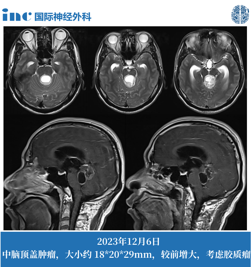 36岁男性--四叠体区占位；梗阻性脑积水影像