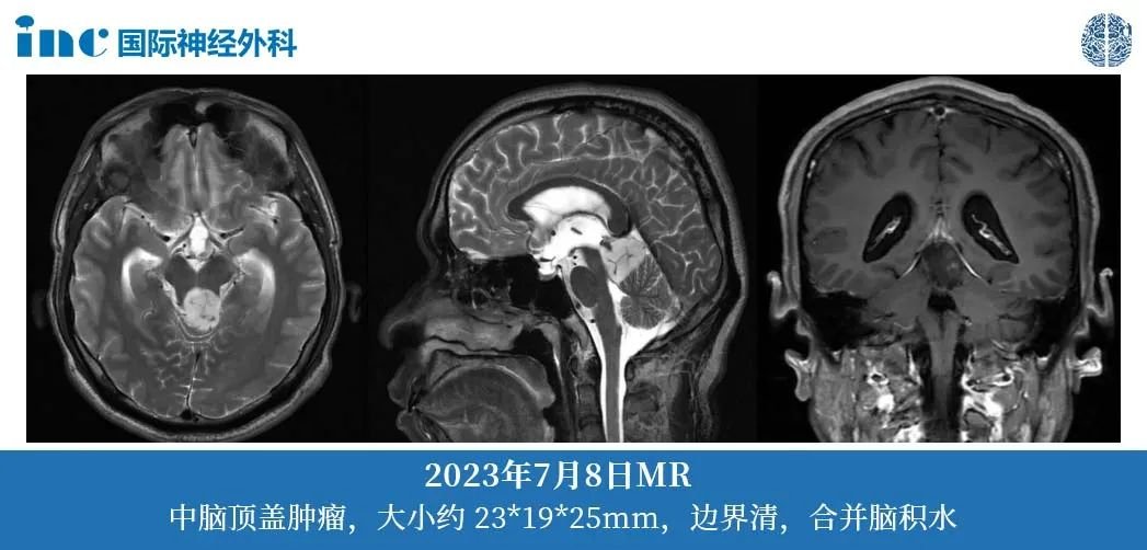 36岁男性--四叠体区占位；梗阻性脑积水