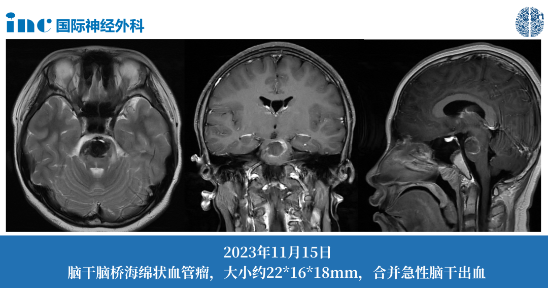 11岁男孩--脑干海绵状血管瘤