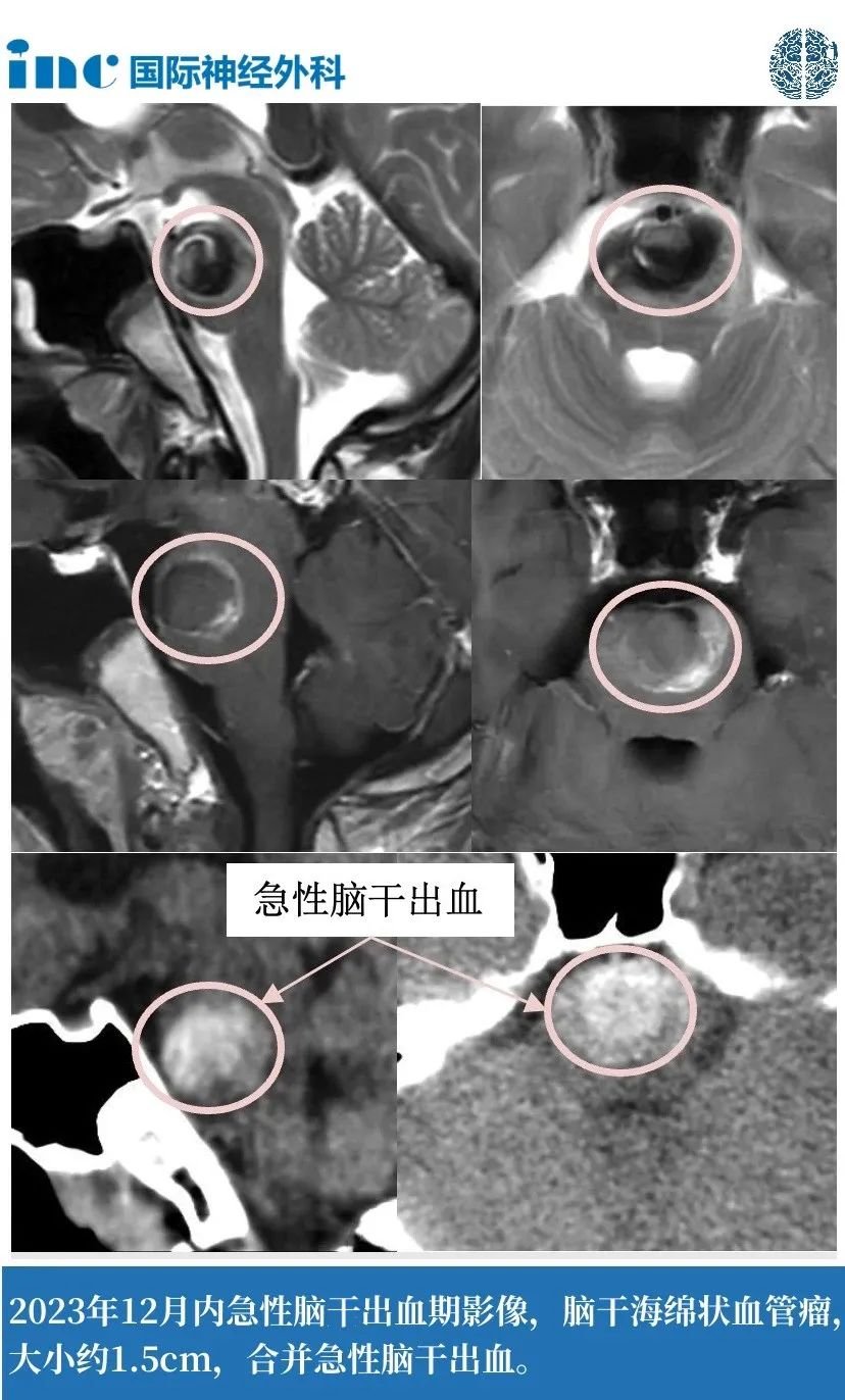 11岁男孩--脑干海绵状血管瘤案例