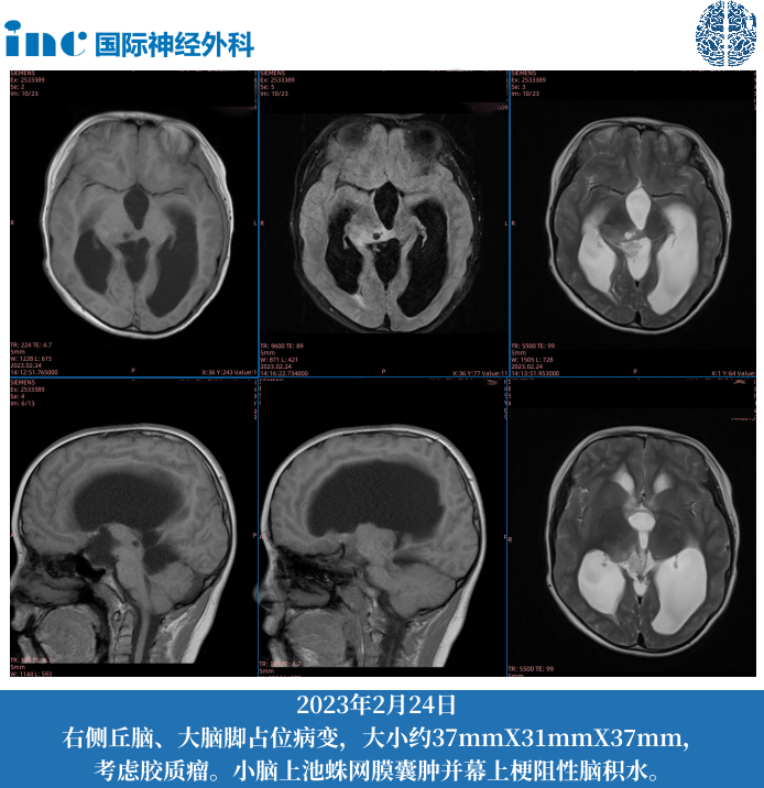 11岁男孩--中脑-丘脑占位；梗阻性脑积水（侧脑室腹腔分流术后）