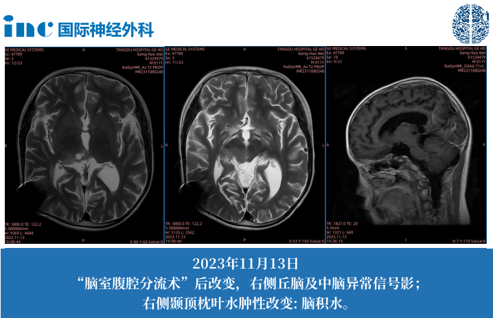 11岁男孩--中脑-丘脑占位；梗阻性脑积水（侧脑室腹腔分流术后）