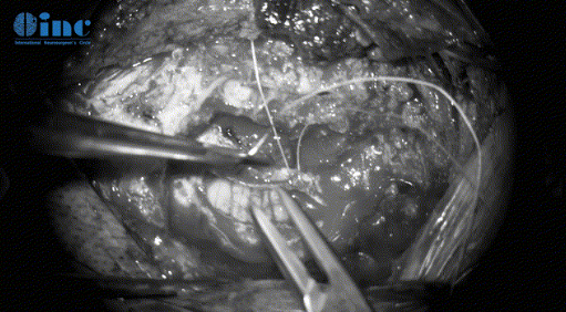 切开及悬吊脑膜膜(暴露手术入路、保护脑组织)