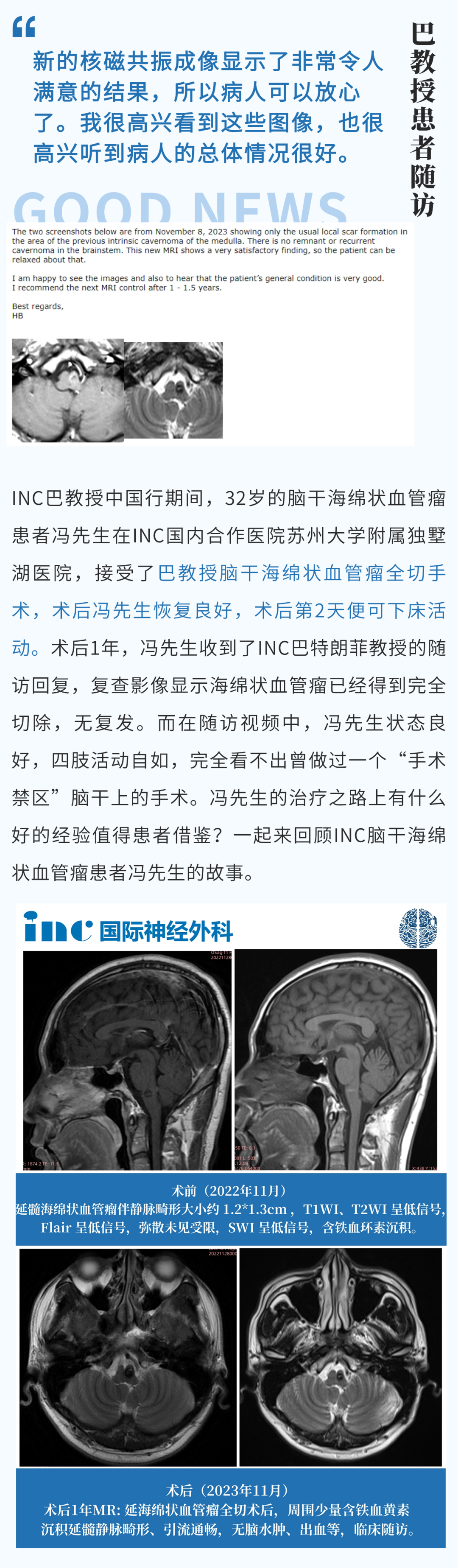 32岁脑干-延髓海绵状血管瘤患者