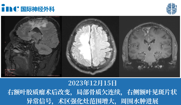 额叶胶质母细胞瘤术后症状加重