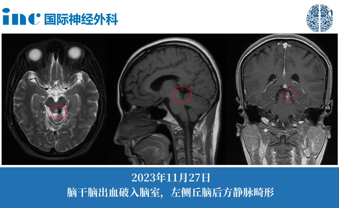 静脉畸形伴出血、开颅手术、介