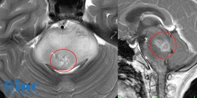 9岁女孩脑桥弥漫中线胶质瘤（