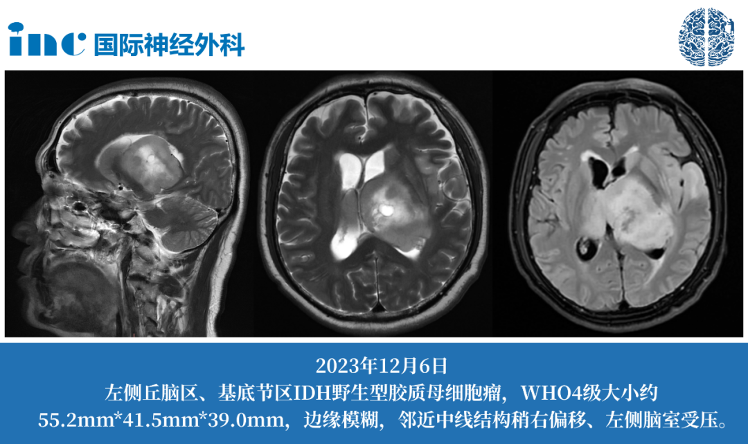 61岁男性左侧丘脑-基底节-颞叶胶质瘤