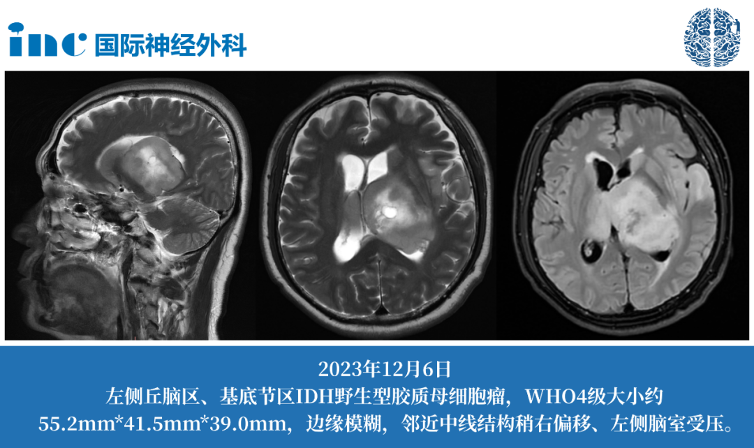 61岁男性左侧丘脑-基底节-颞叶胶质瘤，穿刺活检后四级，还有手术机会吗？