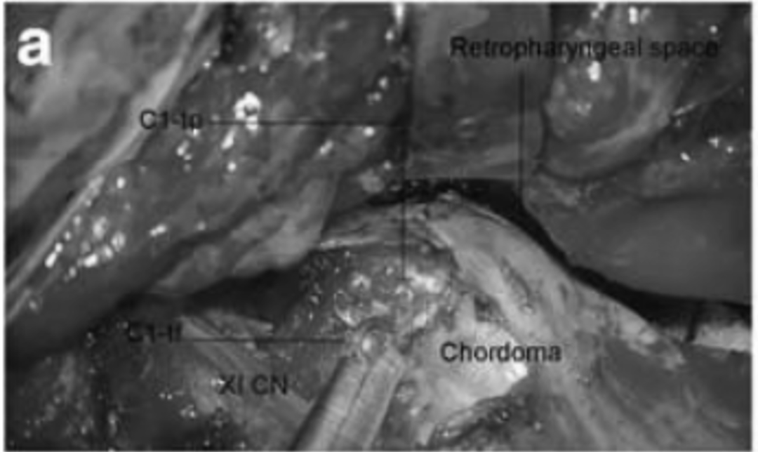 步骤a：C1定位，并暴露C1横突孔。椎动脉通过硬脑膜从C3横孔转移到椎动脉的入口点。注意不要打开蝶窦。