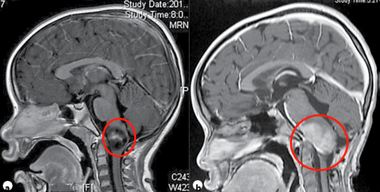 一名7岁儿童浸润性颈髓肿瘤的矢状面造影后t1加权MRI(a)
