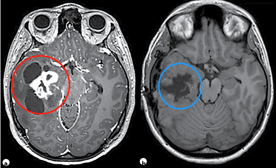 11岁患儿，右颞部肿瘤多发囊肿并增强强化的实性瘤体部分，术前和术后轴位t1加权MRI对比，提示肿瘤被完全切除，最终病理诊断为神经节胶质瘤