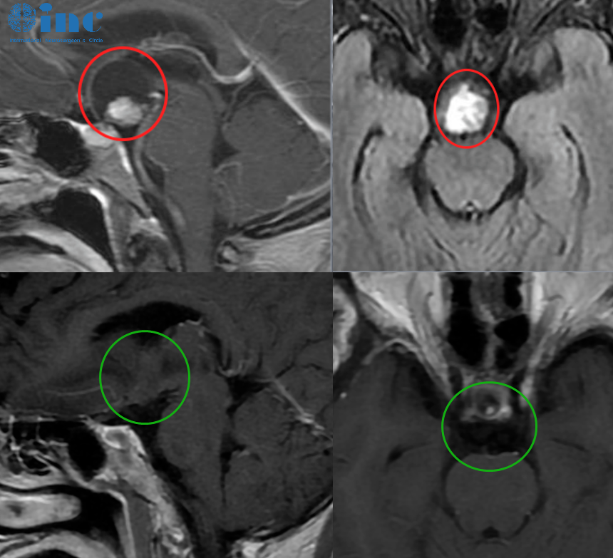 术前术后影像对比，红色为术前肿瘤位置，绿色为术后切除效果