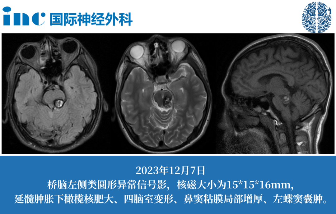 16岁男孩脑干海绵状血管瘤伴HO