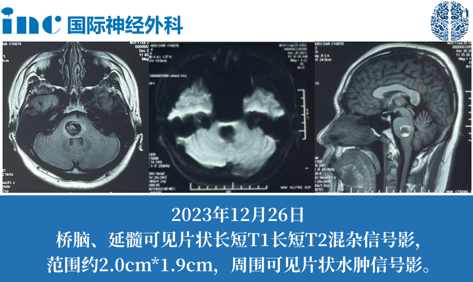 31岁男性脑干海绵状血管瘤致全身