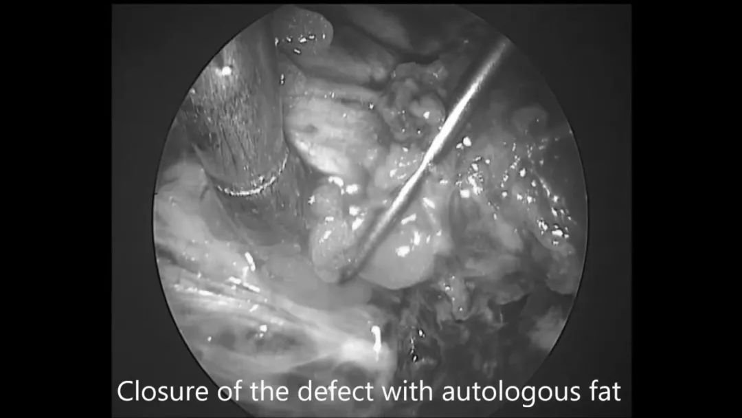 使用自体脂肪填充瘤腔及关颅