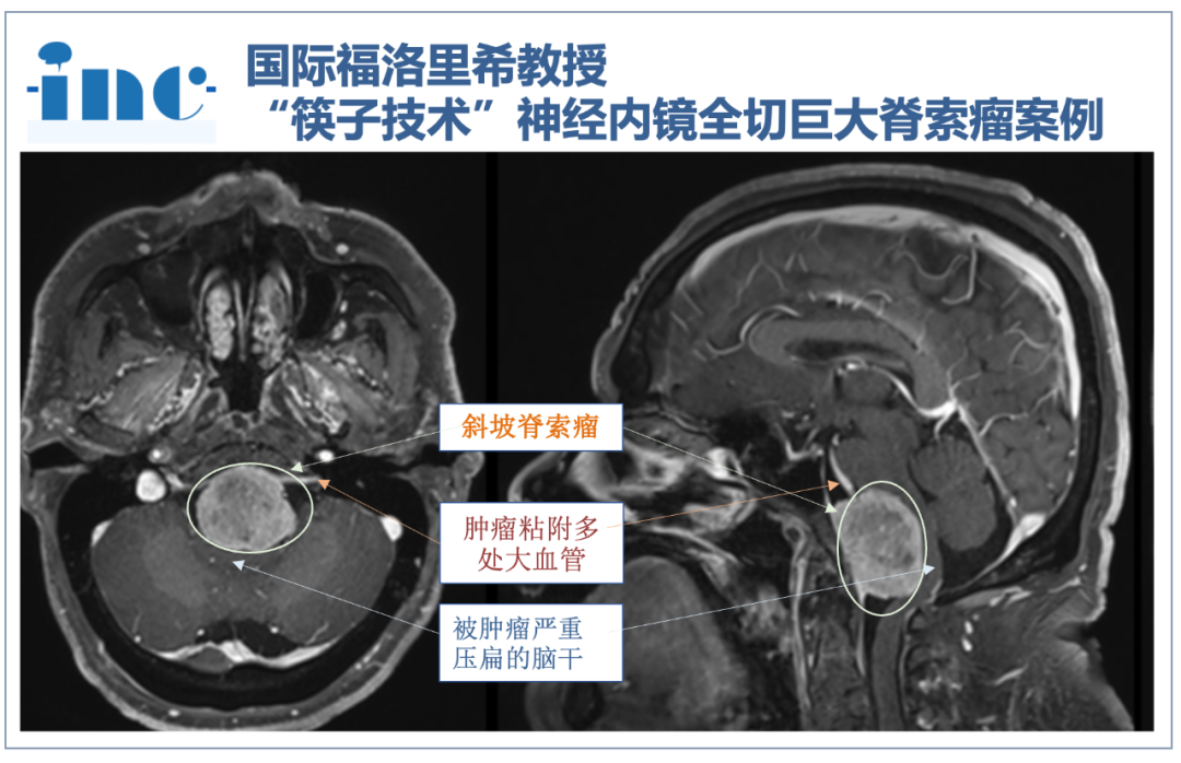 57岁男士巨大脊索瘤压扁脑干，福教授右神经内镜”筷子技术“安全全切
