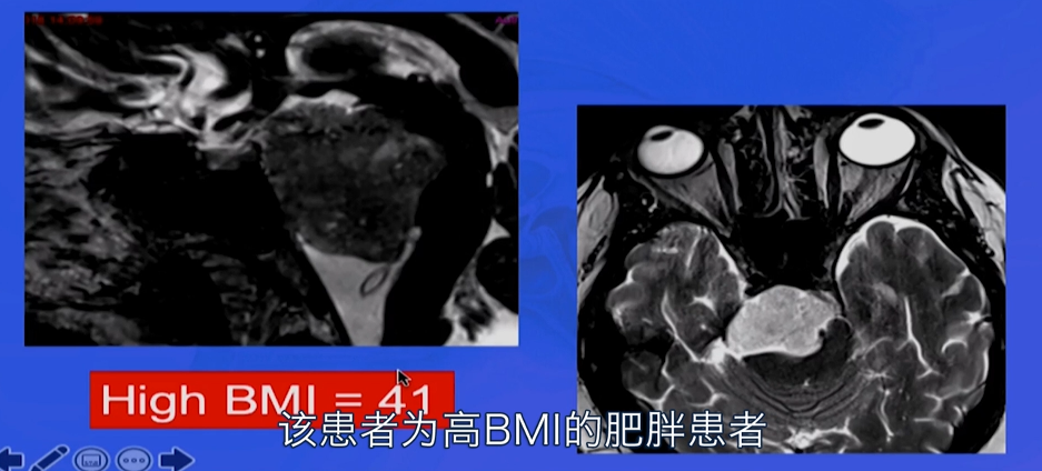 高MBI肥胖患者硬膜内脊索瘤，福教授右神经内镜”筷子技术“安全全切