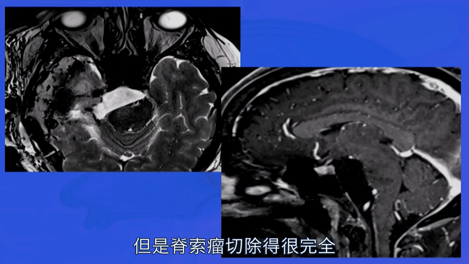 福教授对这个病人的治疗方法很满意，脊索瘤切除得很完全（影像瘤腔白色部分为脂肪填充），并且这个病人受益于这个手术入路，且没有产生并发症。