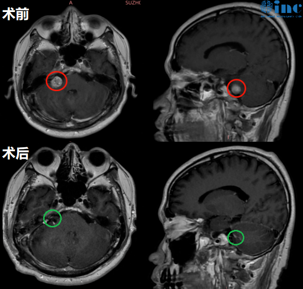 听神经瘤真实案例