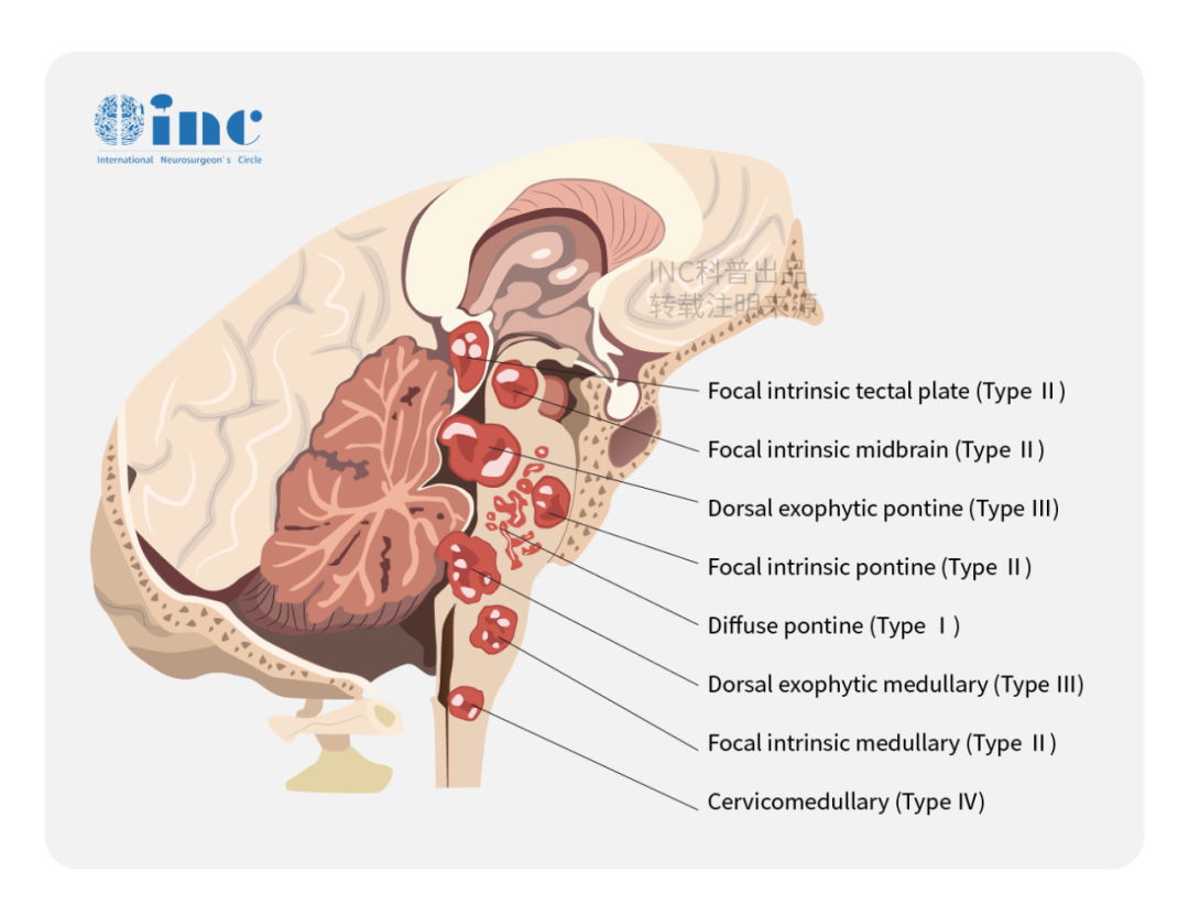 脑干肿瘤分类，可以来自中脑、脑桥、延髓及高位颈髓部位，根据肿瘤生长特点可以分为局灶型、外生型、弥漫型，不同型治疗或预后会有差别