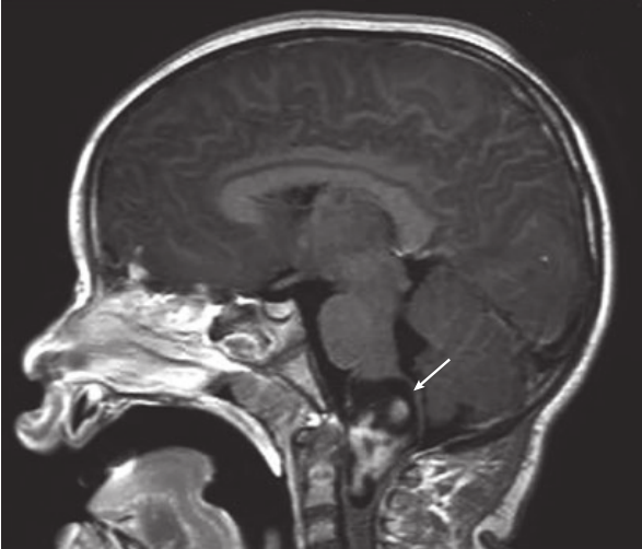 一名6岁女孩的矢状位MRI显示强化的延髓-颈髓交界处的病变。这个孩子最初表现为<a href='/dianxian/' target='_blank'><u>癫痫</u></a>发作，但后来表现出进行性左侧偏瘫