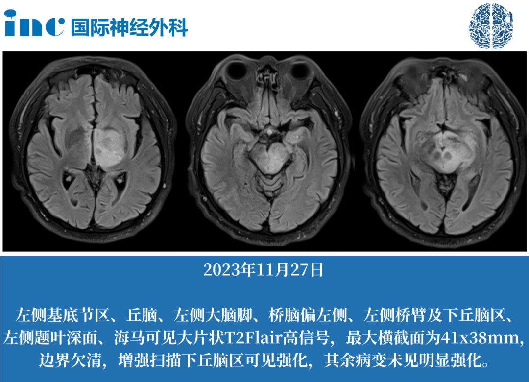 59岁疑难神外疾病患者，不出国门，如何咨询国际脑干教授