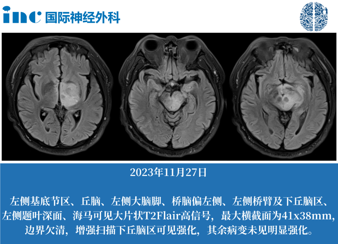 不建议手术 VS 尽快手术，看看巴