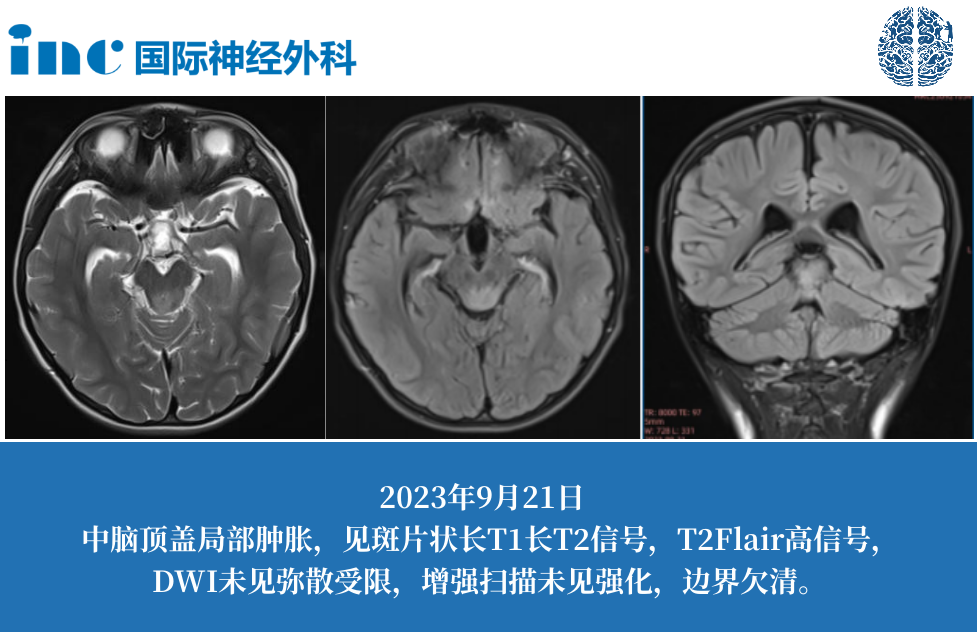 7岁男孩脑干中脑病变，巴教授能否可以手术？手术时机是何时？