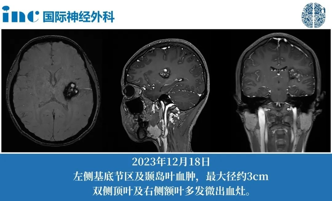 26岁女性基底节海绵状血管瘤2次出血，症状加重，这次该如何应对？