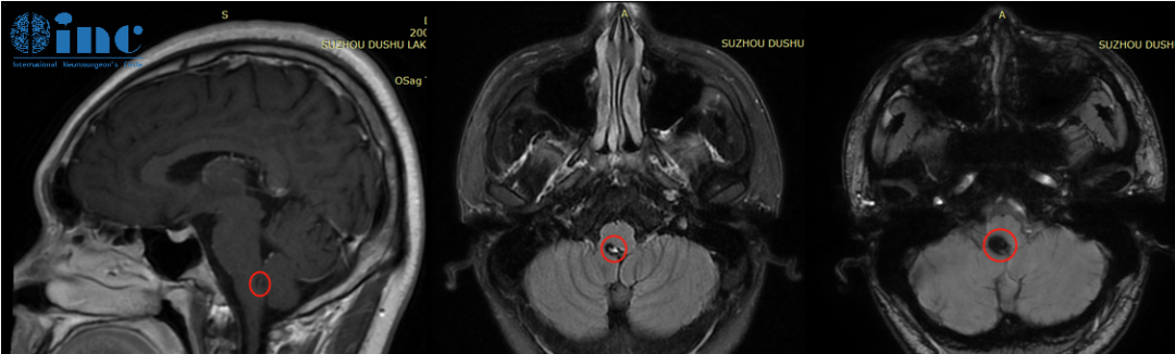 脑干海绵状血管瘤患者案例