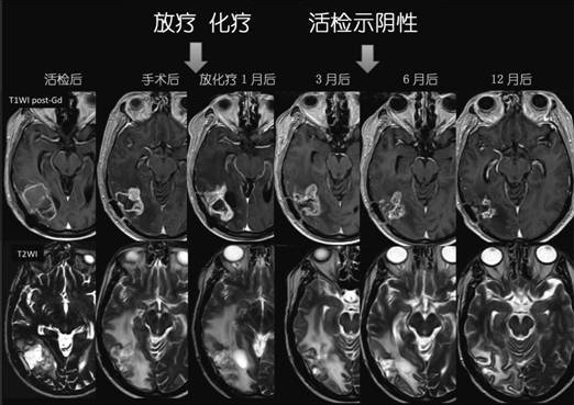 假性进展病例:患者男性,59岁,活检报告胶质母细胞瘤,替莫唑胺同步放化疗1个月后出现磁共振増强范围扩大,6个月后逐渐消退