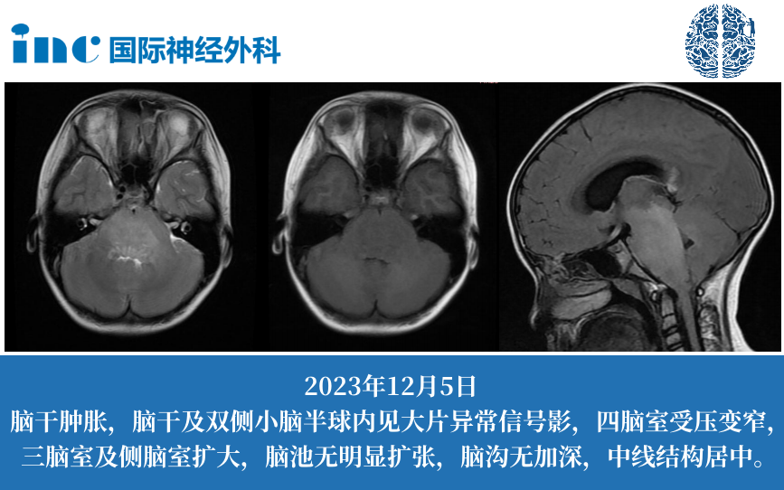 抗击“死亡恶魔”DIPG，国际上都