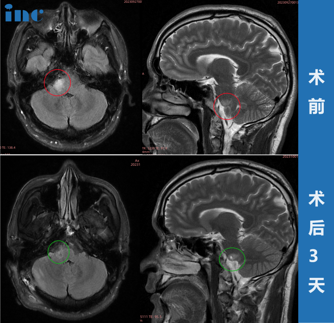 33岁男士-桥臂胶质瘤 脸麻、面瘫