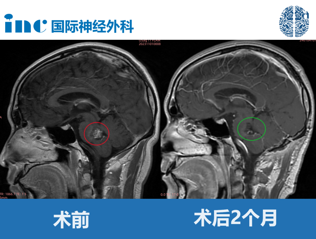 30岁男性-脑干海绵状血管瘤，可以安全全切、无并发症吗？