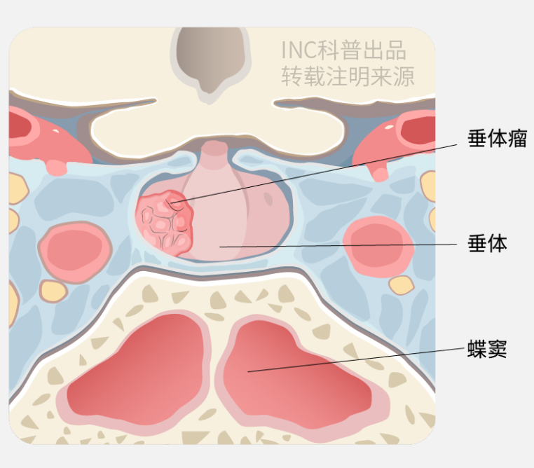图示蓝色区域为海绵窦，海绵窦包围垂体复合体，包含颅神经(CNs)III、IV、V1、V2和VI，颈内动脉(ICA)的海绵段和颈动脉周围交感神经丛。颅神经III、IV和VI被蛛网膜鞘和蛛网膜颗粒包围，海绵窦内脑膜瘤由此产生。