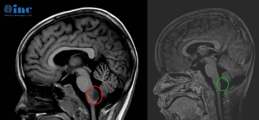 儿童脑肿瘤——影像对比