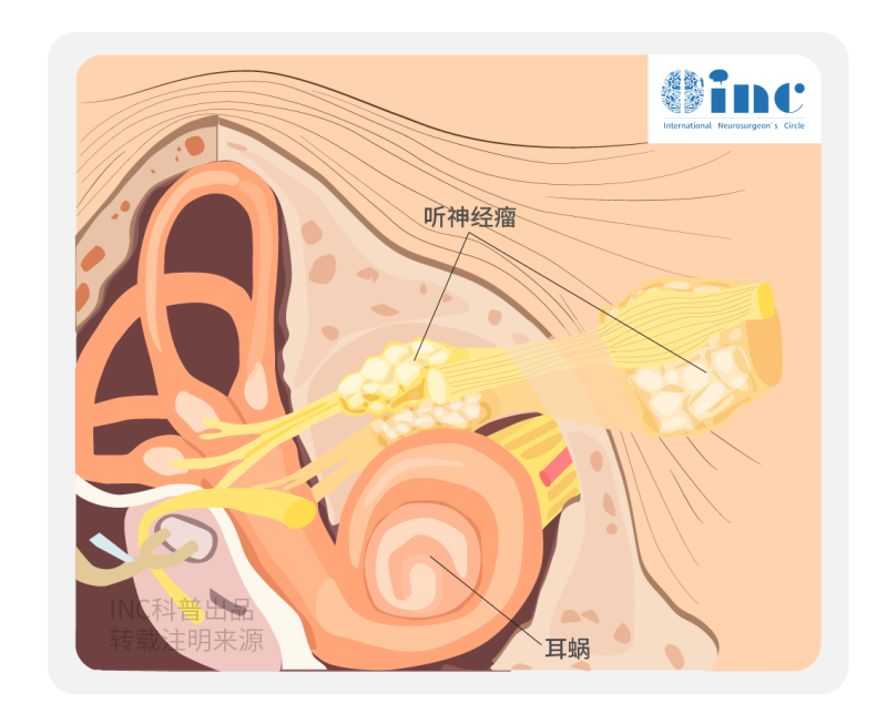 听神经瘤是良性还是恶性肿瘤？