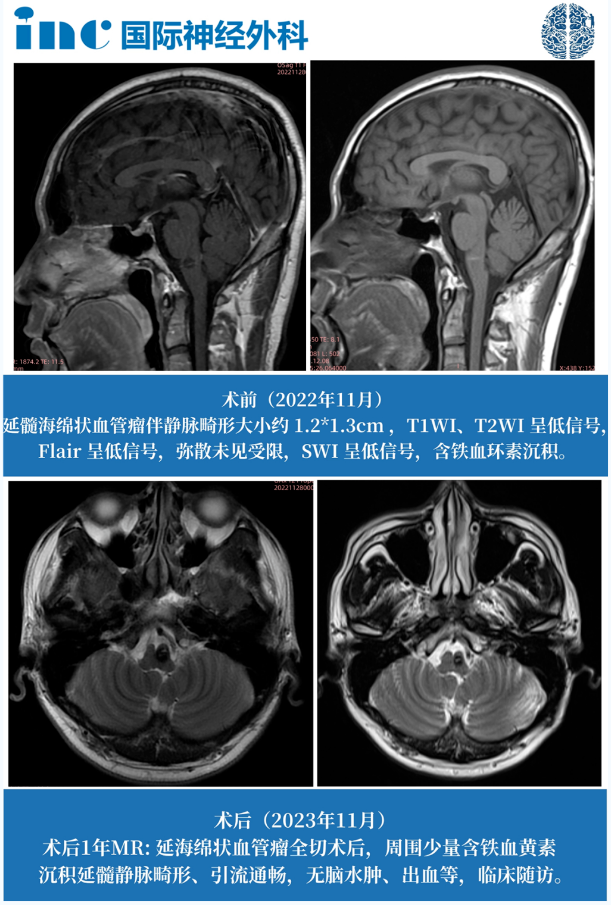 脑干海绵状血管瘤伽马刀治疗合适吗？
