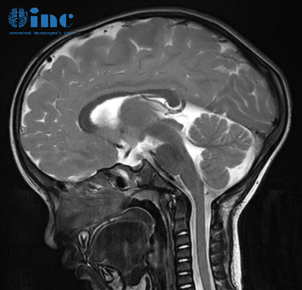 总之，神经影像学研究证实了矢状缝早闭的临床诊断，但在这个特定的孩子中应该被认为是中度。检查排除了异常的脑脊液动力学，以及由于颅骨侧向生长受限而导致的脑实质受损区域。额部和枕部隆起是未经治疗的矢状缝早闭的自然代偿。