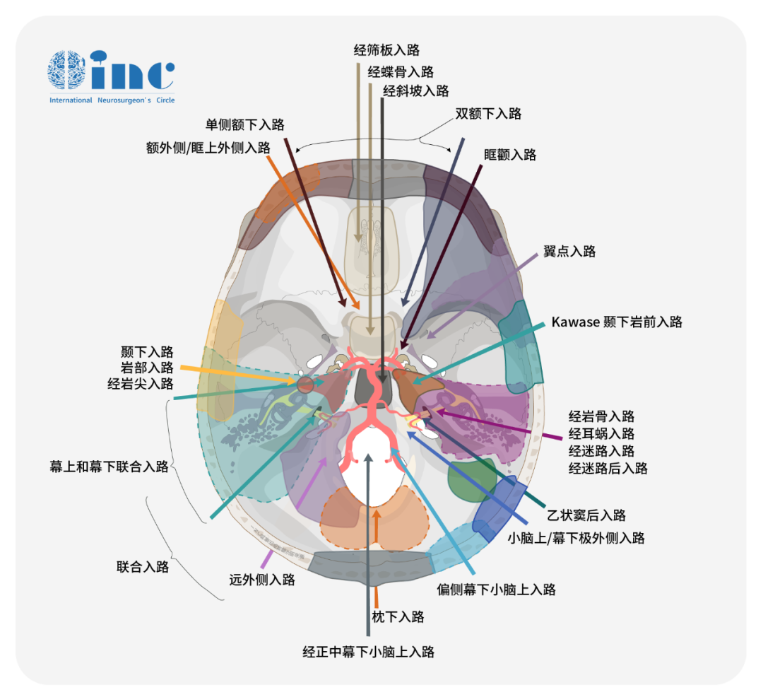 全球64项研究1555例嗅沟脑膜瘤手术-开颅vs内镜手术之争？INC世界颅底大咖福教授