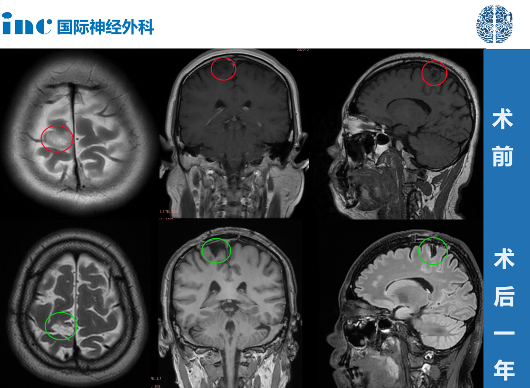 功能区胶质瘤术后1年案例