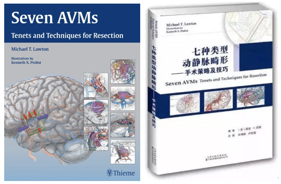 Lawton教授动静脉畸形手术技巧专著及中文翻译版本，包含700多幅精美的彩色插图，对AVM进行明确分类及精准手术路径进行介绍，详尽阐述动静脉畸形切除术的策略，总结常见动静脉畸形临床特征
