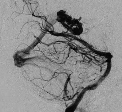 17岁男孩，表现为来自于右侧胼胝体压部AVM的脑室内出血(补充Spetzler-Martin分级4级:S1V1E1/A1B0C0)，SplenA供血，SplenV和内侧AtrV引流右椎动脉造影。