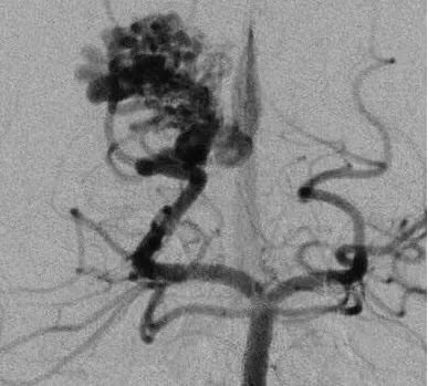 17岁男孩，表现为来自于右侧胼胝体压部AVM的脑室内出血(补充Spetzler-Martin分级4级:S1V1E1/A1B0C0)，SplenA供血，SplenV和内侧AtrV引流右椎动脉造影。