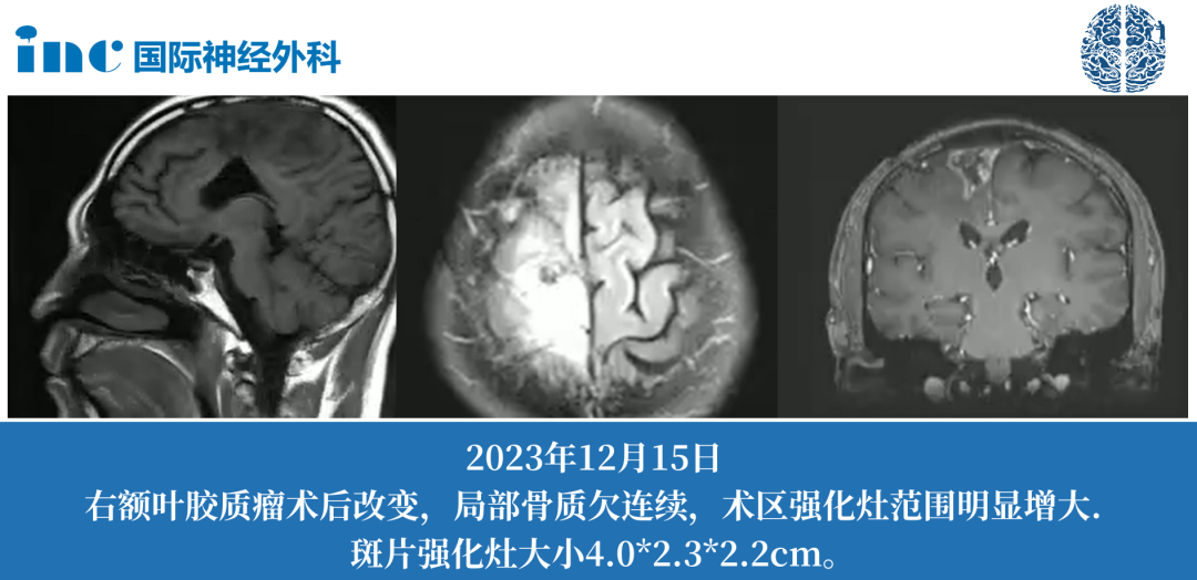 唐先生45岁男性-右额胶质母细胞瘤