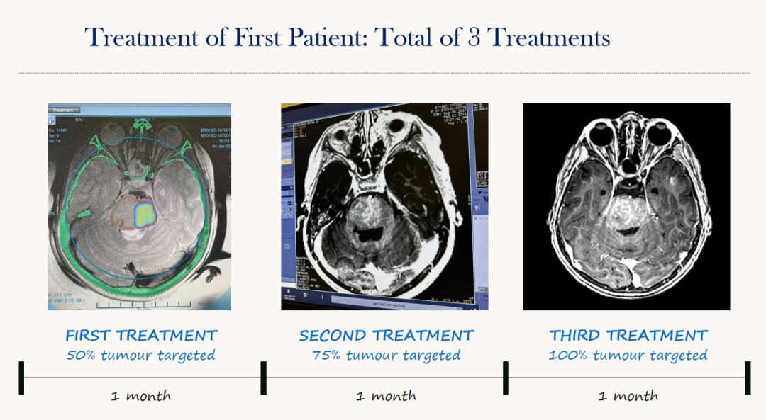 第一例患者的治疗:共3次治疗