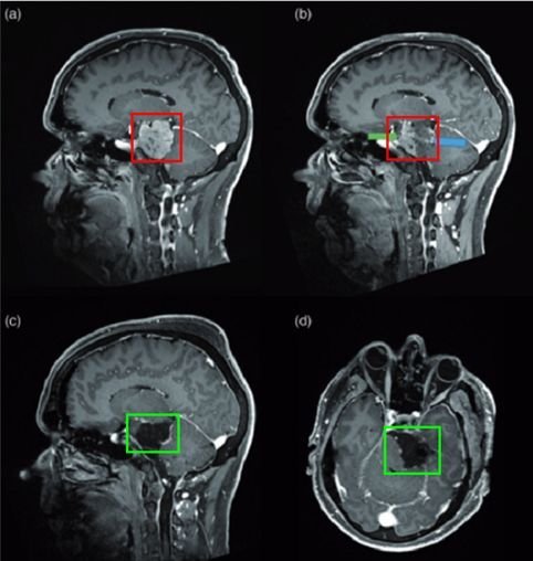 53岁男士-岩斜区脑膜瘤复杂位置，还能安全手术吗？