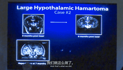 新兴微创激光技术LITT的合适性