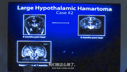 新兴微创激光技术LITT的有效性